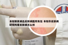 阜陽銀屑病選皮膚病醫(yī)院有信 阜陽市皮膚病研究所看皮膚病怎么樣
