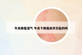 牛皮癬是濕氣 牛皮個癬是血熱引起的嗎
