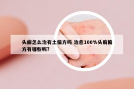 頭癬怎么治有土偏方嗎 治愈100%頭癬偏方有哪些呢?