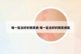 唯一能治好的銀屑病 唯一能治好的銀屑病是