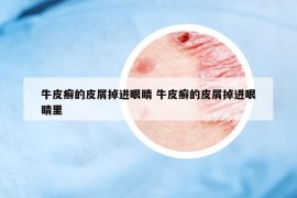 牛皮癬的皮屑掉進(jìn)眼睛 牛皮癬的皮屑掉進(jìn)眼睛里