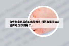 父母都是銀屑病的遺傳概率 媽媽有銀屑病會(huì)遺傳嗎,潛伏期幾年