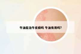 牛油能治牛皮癬嗎 牛油有用嗎?