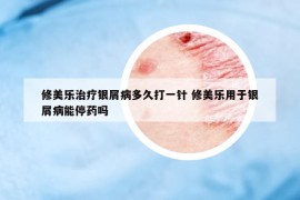 修美樂(lè)治療銀屑病多久打一針 修美樂(lè)用于銀屑病能停藥嗎