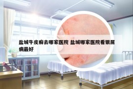 鹽城牛皮癬去哪家醫(yī)院 鹽城哪家醫(yī)院看銀屑病最好