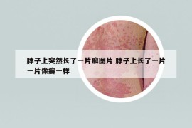 脖子上突然長(zhǎng)了一片癬圖片 脖子上長(zhǎng)了一片一片像癬一樣