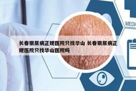 長春銀屑病正規(guī)醫(yī)院只找華山 長春銀屑病正規(guī)醫(yī)院只找華山醫(yī)院嗎