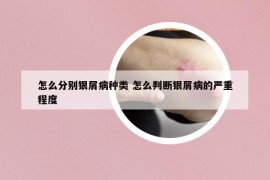 怎么分別銀屑病種類 怎么判斷銀屑病的嚴(yán)重程度