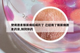 使用激素銀屑病后成片了 已經(jīng)用了銀屑病激素藥膏,如何停藥