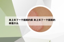 身上長了一個圓圈的癬 身上長了一個圓圈的癬是什么