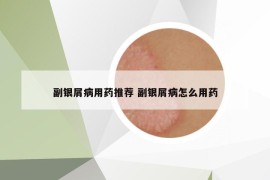 副銀屑病用藥推薦 副銀屑病怎么用藥