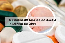 牛皮癬好轉(zhuǎn)的時候為什么還會紅點 牛皮癬好了以后為啥皮膚是白色的
