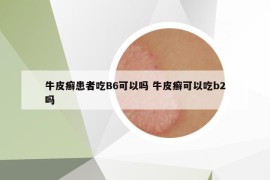 牛皮癬患者吃B6可以嗎 牛皮癬可以吃b2嗎