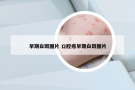早期白斑圖片 口腔癌早期白斑圖片