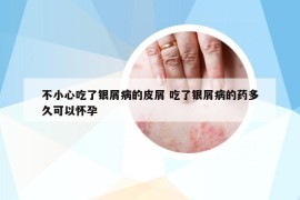 不小心吃了銀屑病的皮屑 吃了銀屑病的藥多久可以懷孕
