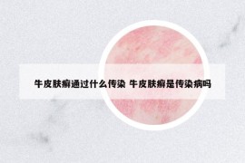 牛皮膚癬通過(guò)什么傳染 牛皮膚癬是傳染病嗎