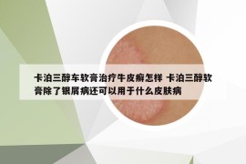 卡泊三醇車軟膏治療牛皮癬怎樣 卡泊三醇軟膏除了銀屑病還可以用于什么皮膚病