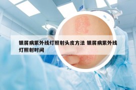 銀屑病紫外線燈照射頭皮方法 銀屑病紫外線燈照射時(shí)間