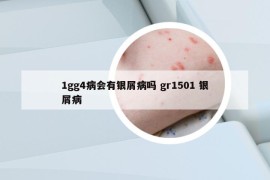 1gg4病會有銀屑病嗎 gr1501 銀屑病