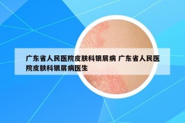 廣東省人民醫(yī)院皮膚科銀屑病 廣東省人民醫(yī)院皮膚科銀屑病醫(yī)生