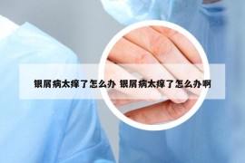 銀屑病太癢了怎么辦 銀屑病太癢了怎么辦啊