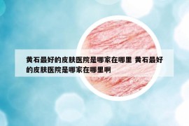 黃石最好的皮膚醫(yī)院是哪家在哪里 黃石最好的皮膚醫(yī)院是哪家在哪里啊
