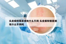 頭皮癬和銀屑病有什么不同 頭皮癬和銀屑病有什么不同嗎