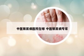 中醫(yī)銀屑病醫(yī)院在哪 中醫(yī)銀屑病專家