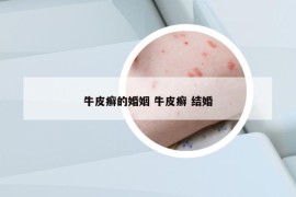 牛皮癬的婚姻 牛皮癬 結(jié)婚