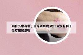 喝什么水有利于治療銀屑病 喝什么水有利于治療銀屑病呢