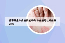姜棗茶患牛皮癬的能喝嗎 牛皮癬可以喝姜棗茶嗎