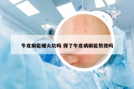 牛皮癬能睡火炕嗎 得了牛皮病癬能熬夜嗎