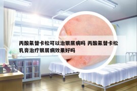 丙酸氟替卡松可以治銀屑病嗎 丙酸氟替卡松乳膏治療銀屑病效果好嗎