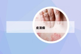 皮清癬