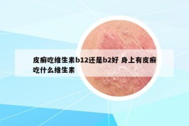皮癬吃維生素b12還是b2好 身上有皮癬吃什么維生素