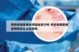 媽媽有銀屑病會(huì)傳染給孩子嗎 母親有銀屑病遺傳概率比父親高嗎