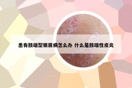 患有肢端型銀屑病怎么辦 什么是肢端性皮炎