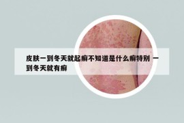 皮膚一到冬天就起癬不知道是什么癬特別 一到冬天就有癬