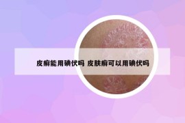 皮癬能用碘伏嗎 皮膚癬可以用碘伏嗎
