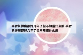 手肘長(zhǎng)得癬都好幾年了但不知道什么癬 手肘長(zhǎng)得癬都好幾年了但不知道什么癬