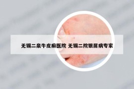 無錫二泉牛皮癬醫(yī)院 無錫二院銀屑病專家
