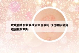 玫瑰糠疹會發(fā)展成副銀屑病嗎 玫瑰糠疹會變成副銀屑病嗎