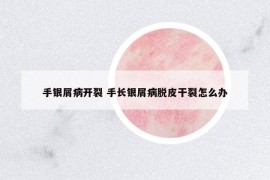 手銀屑病開裂 手長銀屑病脫皮干裂怎么辦