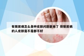 有銀屑病怎么各種皮膚問(wèn)題都來(lái)了 得銀屑病的人皮膚是不是都不好