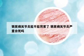 銀屑病關(guān)節(jié)炎能不能勞累了 銀屑病關(guān)節(jié)炎嚴重會死嗎