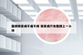 胳膊銀屑病不痛不癢 銀屑病只有胳膊上一小塊