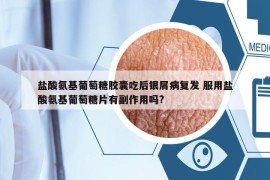 鹽酸氨基葡萄糖膠囊吃后銀屑病復發(fā) 服用鹽酸氨基葡萄糖片有副作用嗎?