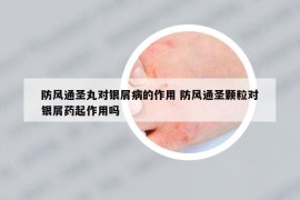防風通圣丸對銀屑病的作用 防風通圣顆粒對銀屑藥起作用嗎