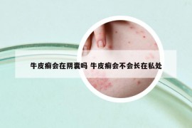 牛皮癬會(huì)在陰囊嗎 牛皮癬會(huì)不會(huì)長在私處