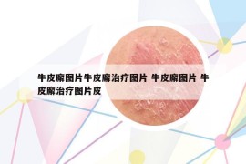 牛皮廨圖片牛皮廨治療圖片 牛皮廨圖片 牛皮廨治療圖片皮